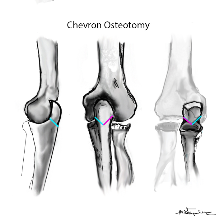 Chevron Osteotomy